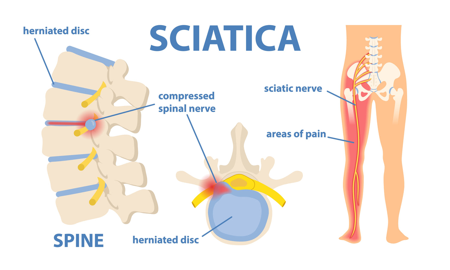 Sciatica - what it is and how to treat it