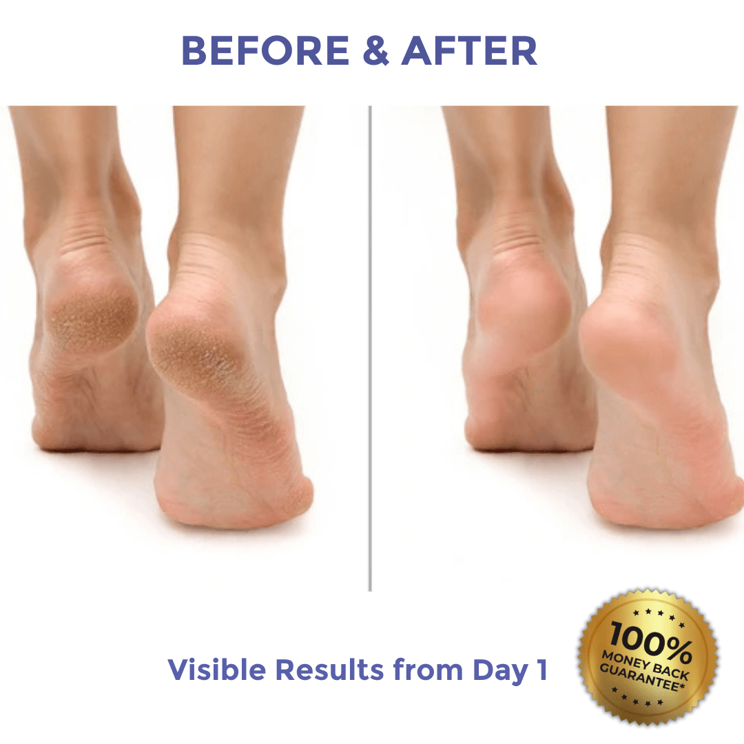 Diamond Luxe Heel Balm for Dry & Cracked Heels visible results before and after