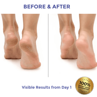 Diamond Luxe Heel Balm for Dry & Cracked Heels visible results before and after