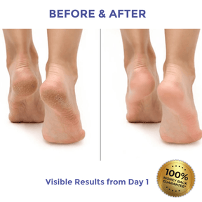 Diamond Luxe Heel Balm for Dry & Cracked Heels visible results before and after